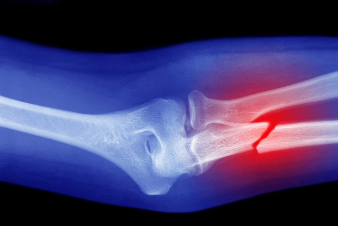 x-ray of broken arm with red circle overlay on the fracture site